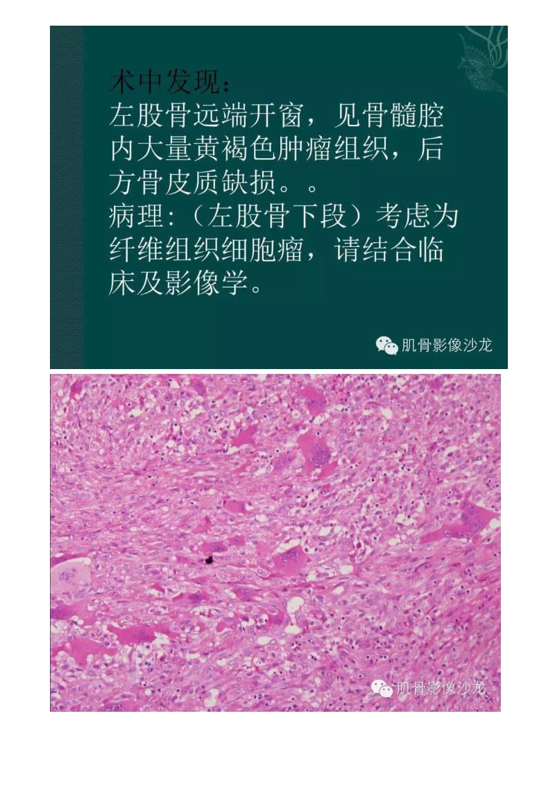 医学影像：良性纤维组织细胞瘤.doc_第3页