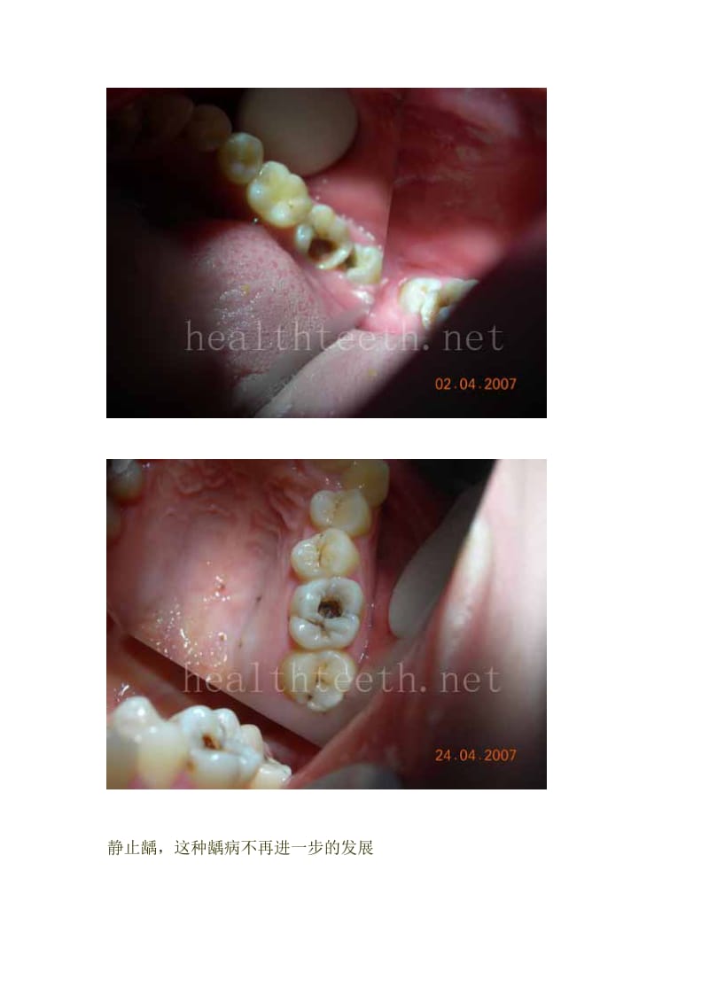 口腔常见疾病图片展.doc_第2页