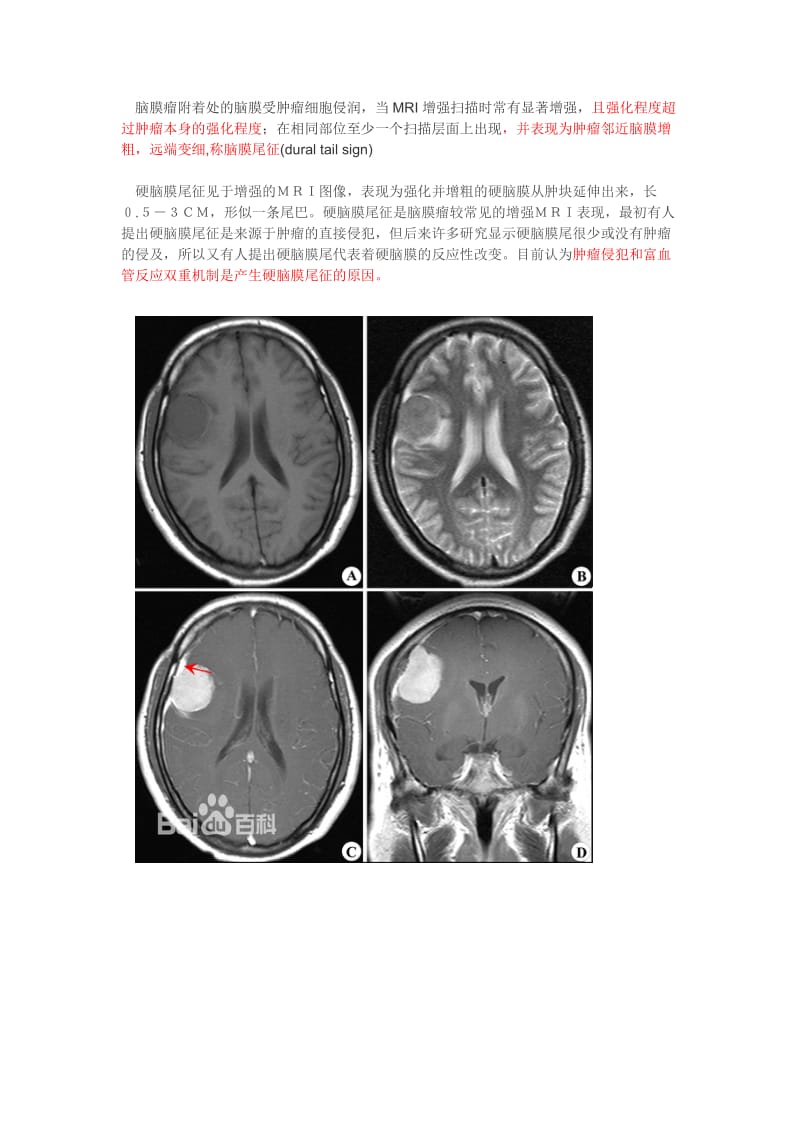 脑膜尾征-脑膜瘤图片.doc_第1页