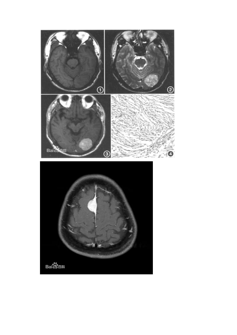脑膜尾征-脑膜瘤图片.doc_第3页