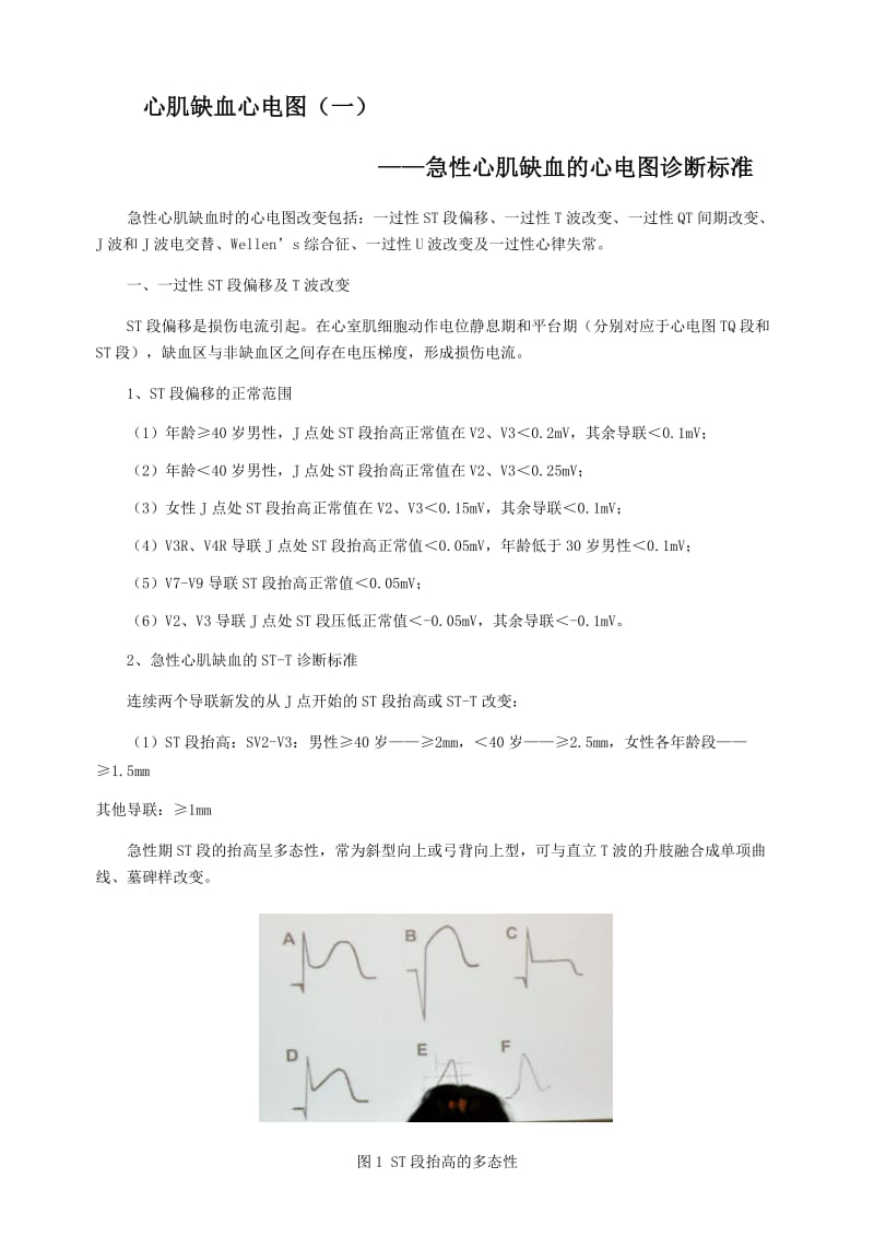 心肌缺血心电图分析.doc_第1页