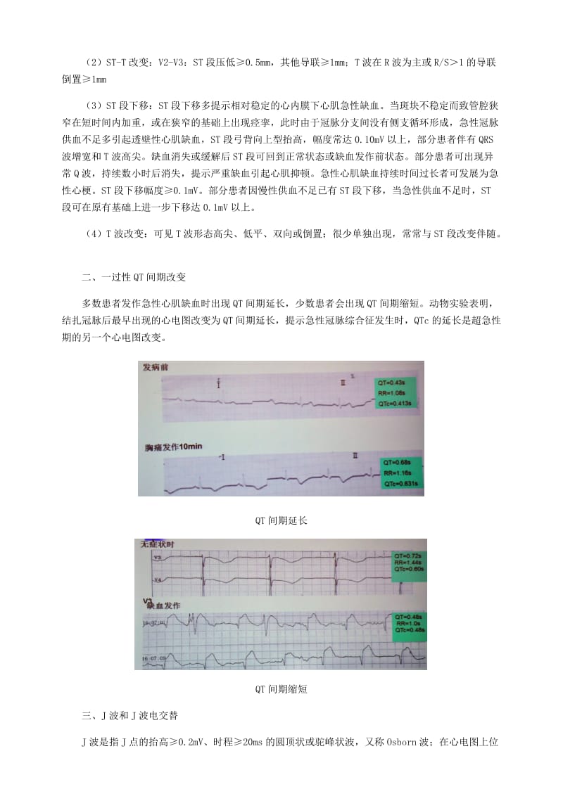 心肌缺血心电图分析.doc_第2页