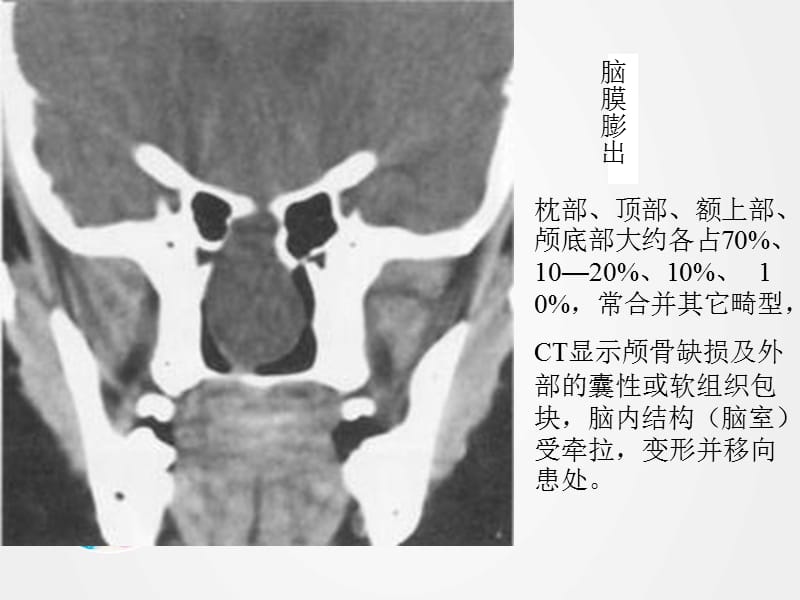 《畸形与脑血管疾病》ppt.ppt_第3页