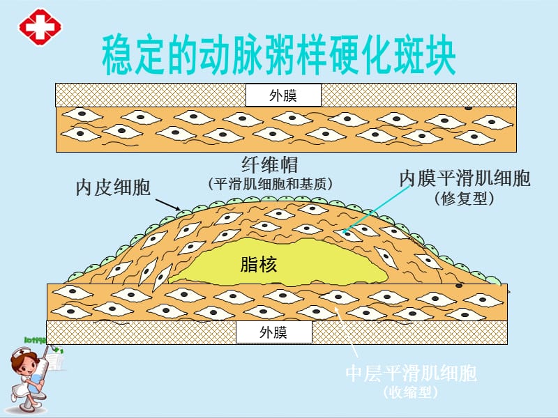 动脉硬化冠心病ppt.ppt_第1页