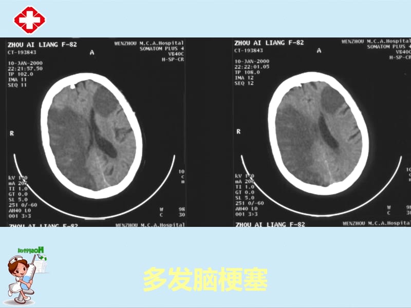 《CT-实习片》ppt.ppt_第2页