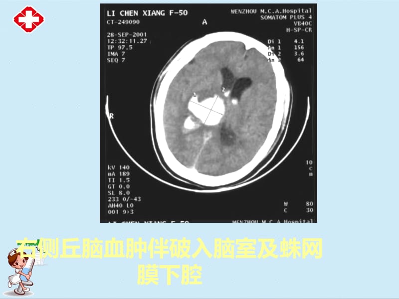 《CT-实习片》ppt.ppt_第3页