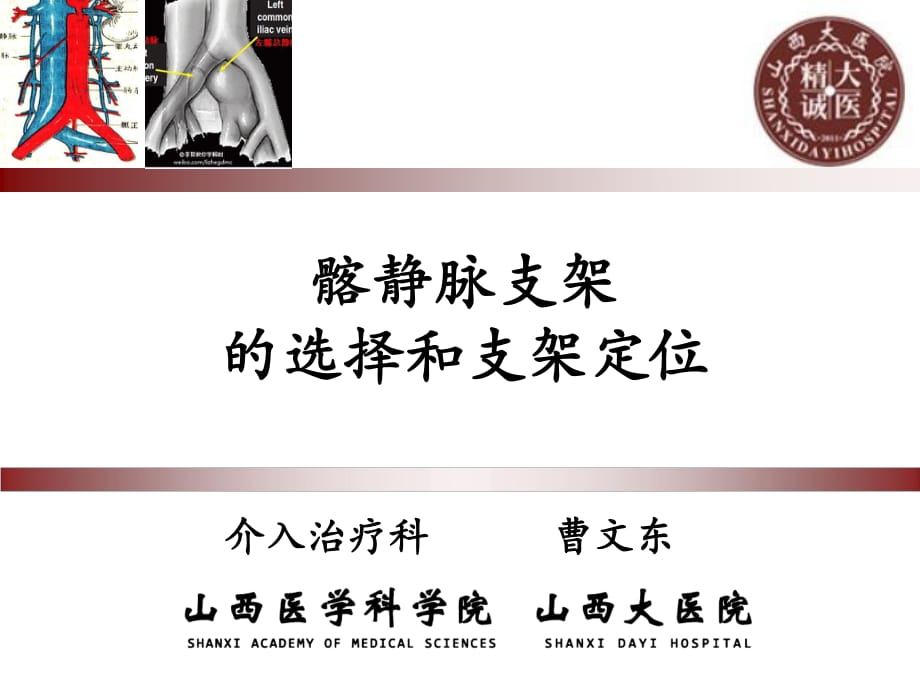 髂靜脈支架的選擇和支架定位.ppt_第1頁(yè)