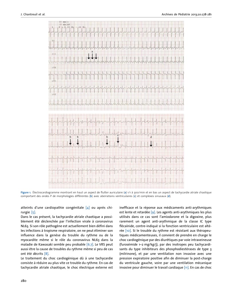 【病毒外文文献】2013 Tachycardie atriale chaotique au cours d_une infection respiratoire _ coronavirus NL63_第3页