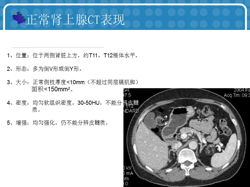 常见肾上腺肿瘤的CT诊断与鉴别诊断.ppt_第3页