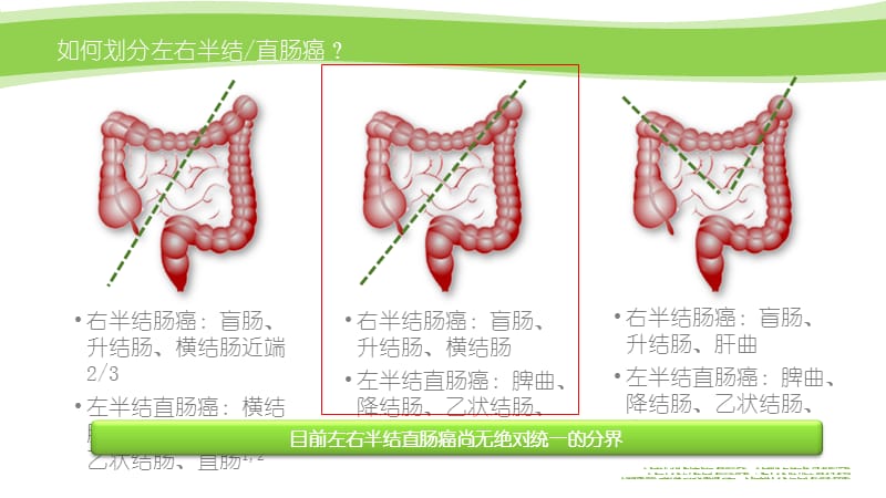 左右半结直肠癌的区别.ppt_第3页