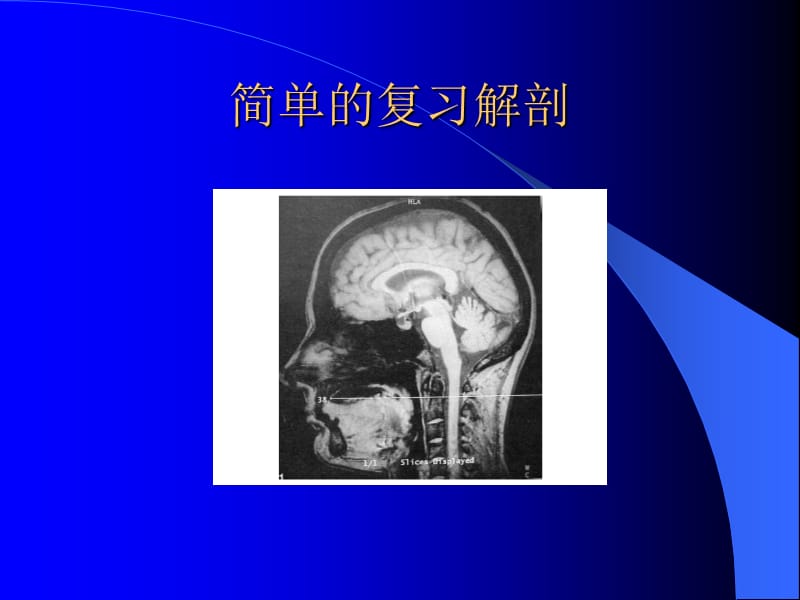 延髓背外侧综合征.ppt_第2页