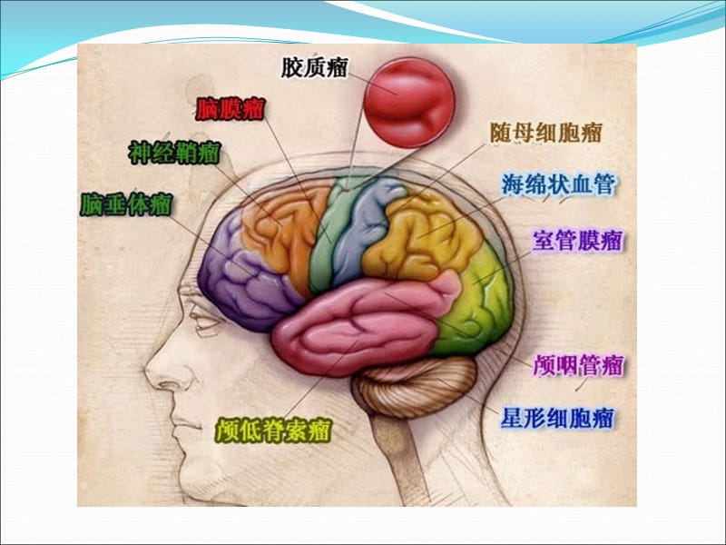 常见脑肿瘤的影像诊断.ppt47630.ppt_第3页