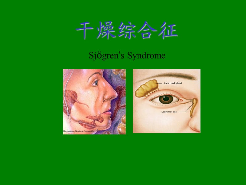 干燥综合症护理.ppt_第1页