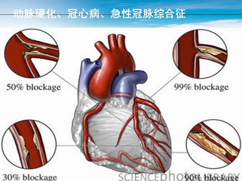 急性冠状动脉综合征.ppt_第2页