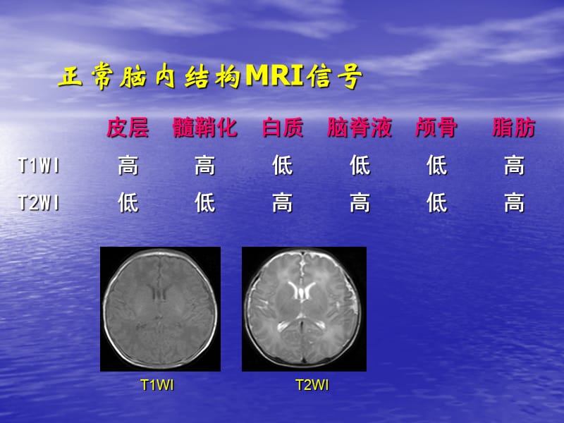 新生儿头部磁共振成像.ppt_第3页