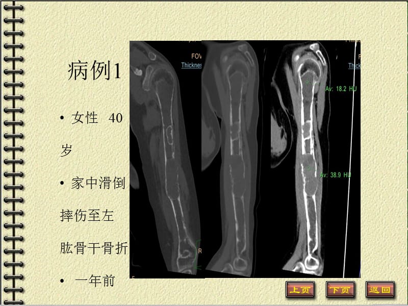 甲状旁腺亢进棕色瘤的影像诊断.ppt_第2页