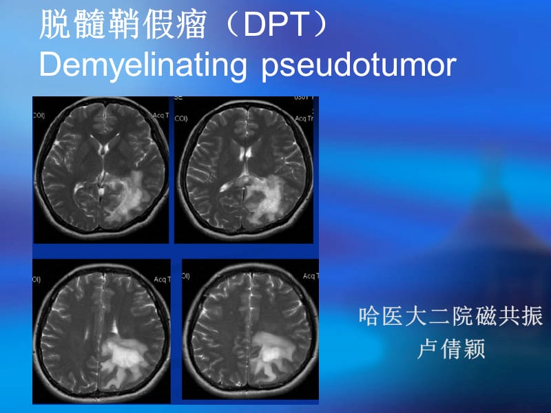 脱髓鞘假瘤MRI诊断.ppt_第1页