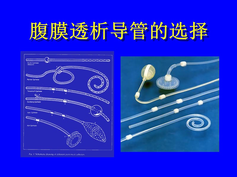 腹膜透析置管术.ppt_第2页