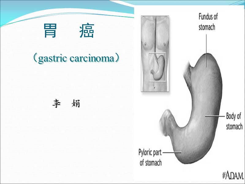 胃癌教学课件.ppt_第1页