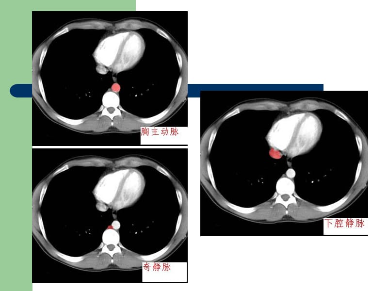 腹部CT诊断(很经典).ppt_第3页