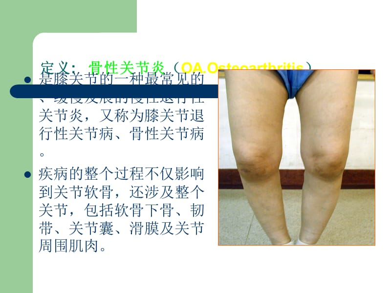膝关节骨性关节炎诊治课件PPT25969.ppt_第2页
