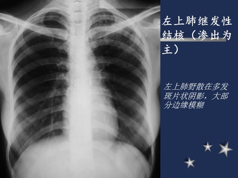 肺结核的影像诊断(X线).ppt_第3页