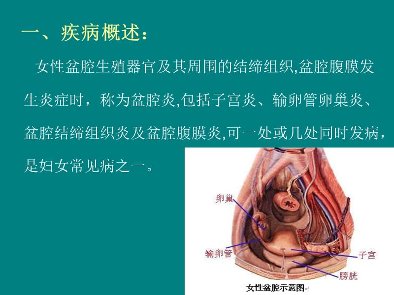 盆腔炎护理.ppt_第3页