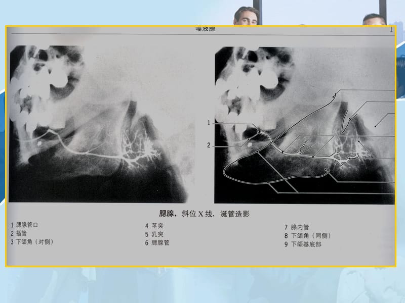 腮腺疾病的影像诊断.ppt_第3页