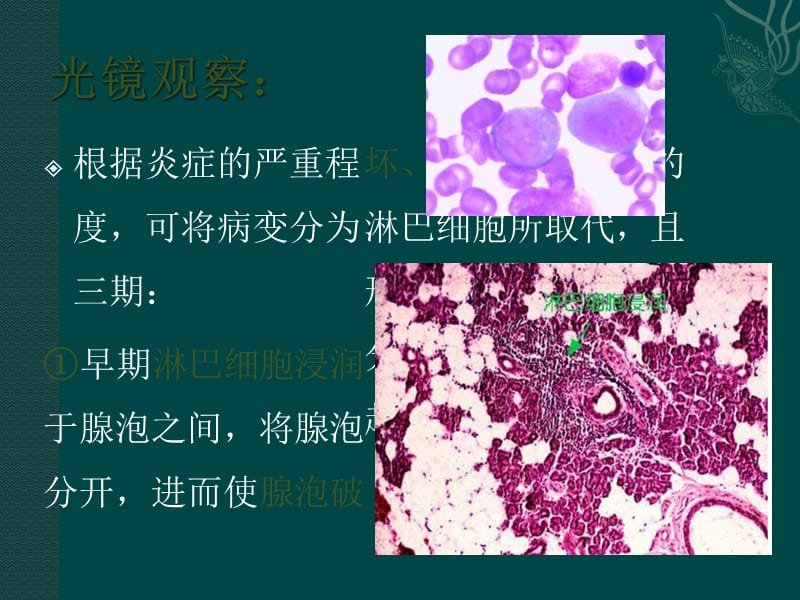 舍格伦综合征病理变化.ppt_第3页