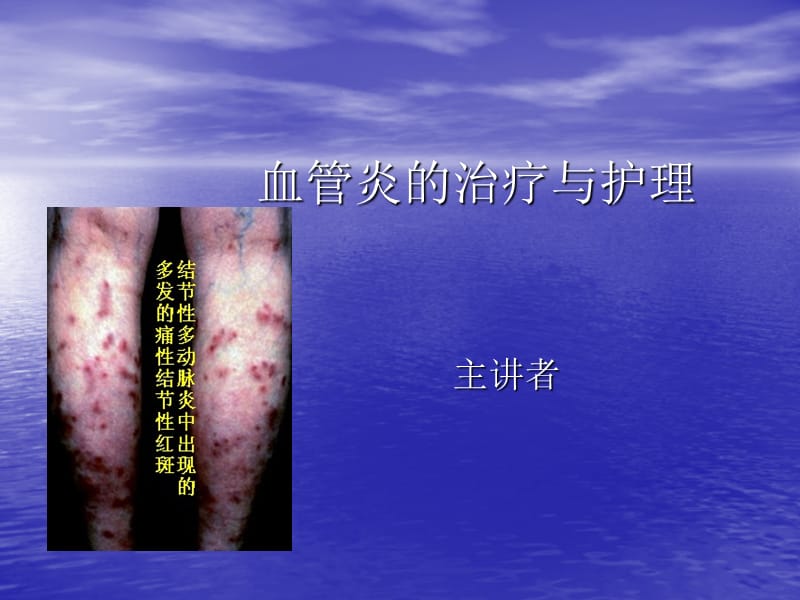 血管炎患者的治疗与护理.ppt_第1页