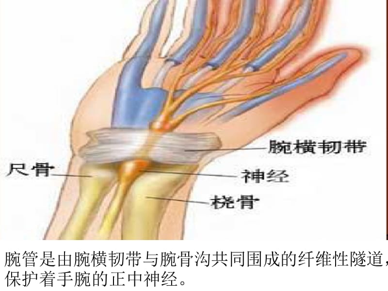 腕管综合征护理.ppt_第3页