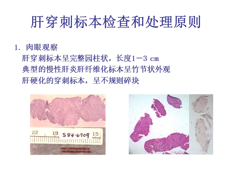 肝病的病理形态特点及免疫组化染色体会.ppt_第2页