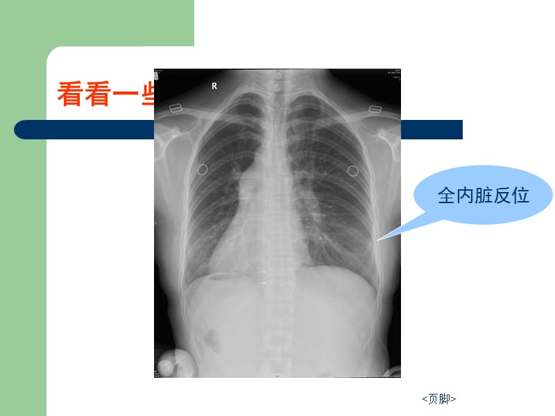 腮腺常见疾病的CT诊断PPT.ppt_第2页