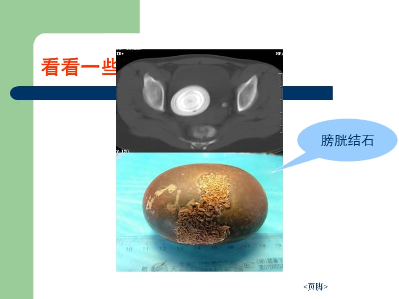 腮腺常见疾病的CT诊断PPT.ppt_第3页