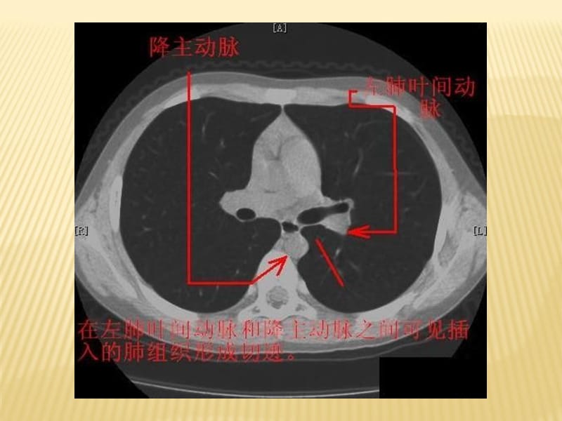 胸部CT断层解剖标注详解.ppt_第3页