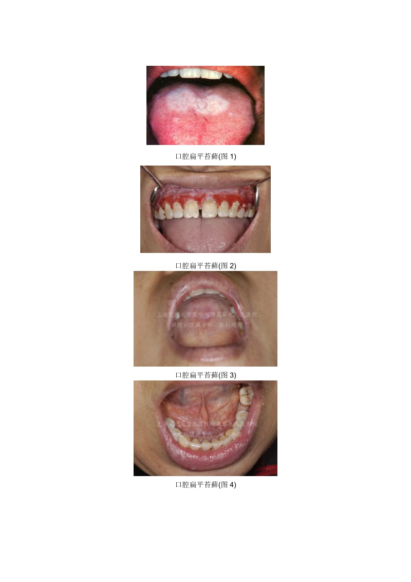 口腔扁平苔藓综述.doc_第2页