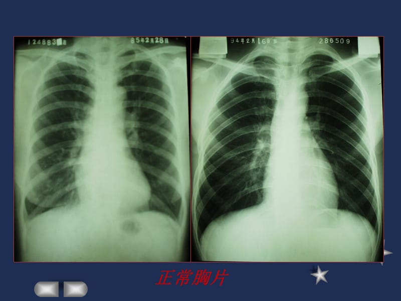 肺结核的影像诊断(X线)48535.ppt_第2页