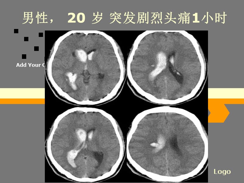 烟雾病影像诊断48563.ppt_第2页