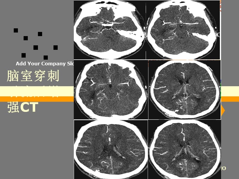 烟雾病影像诊断48563.ppt_第3页