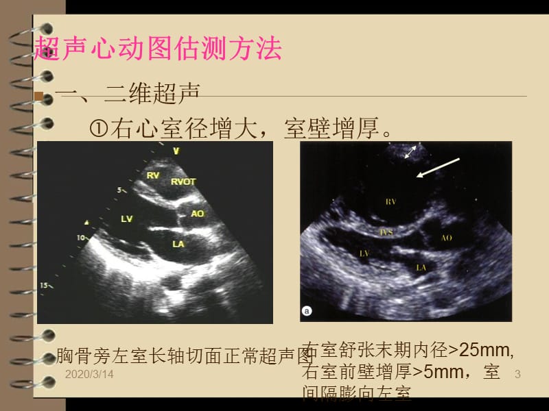 肺动脉高压的超声估测量方法.ppt_第3页