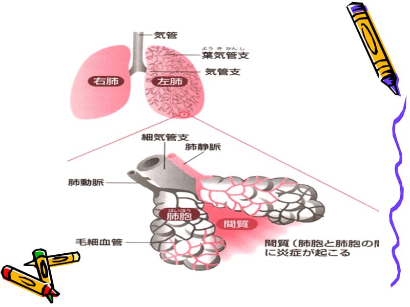 肺炎病人的护理.ppt_第3页