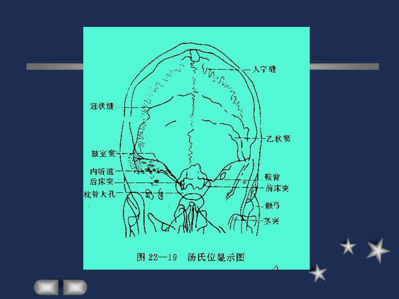 耳内疾病影像诊断.ppt_第3页