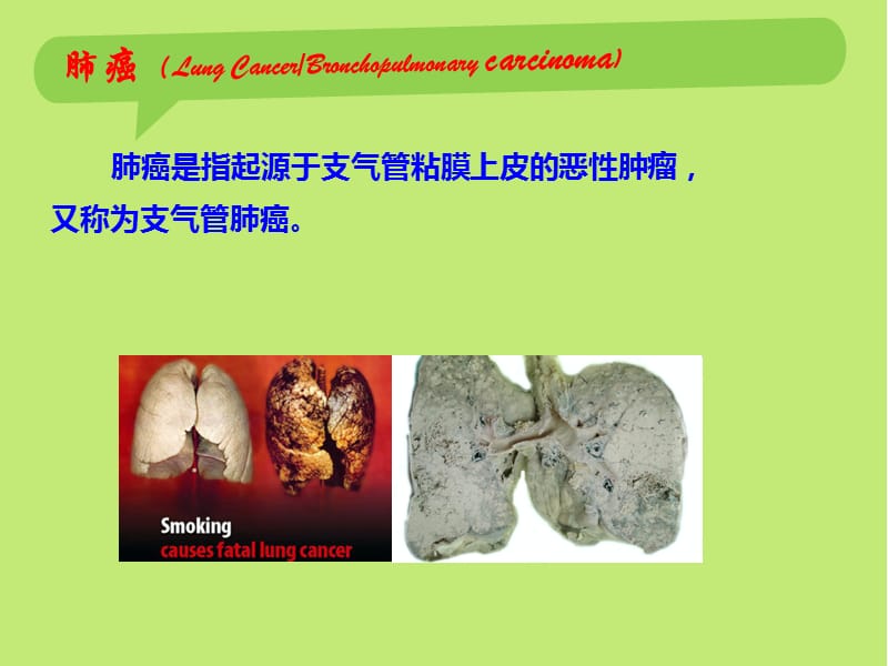 肺癌的早期诊断与防治.ppt_第3页