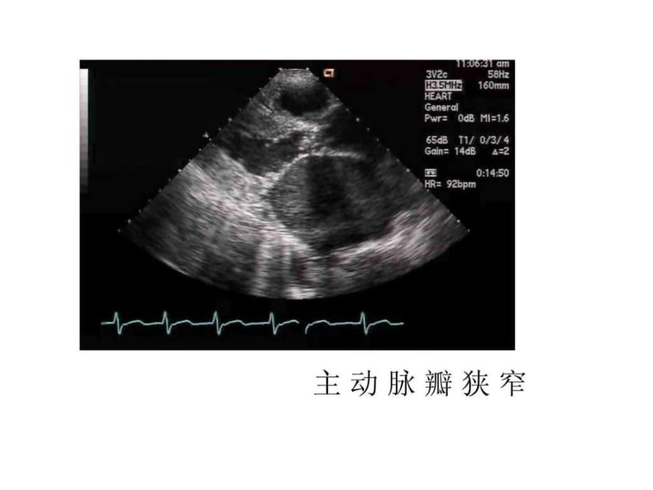 南昌大学超声精品课程之心脏瓣膜病之二_第1页