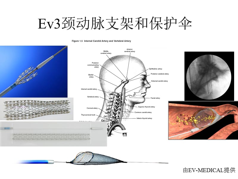 Ev3颈动脉支架和保护伞_第1页