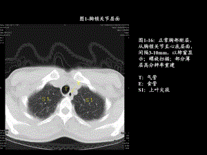 胸部CT图片ppt课件