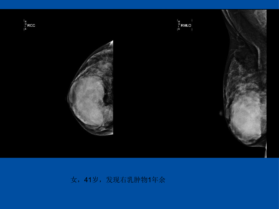 乳腺叶状肿瘤影像表现PPT课件_第1页