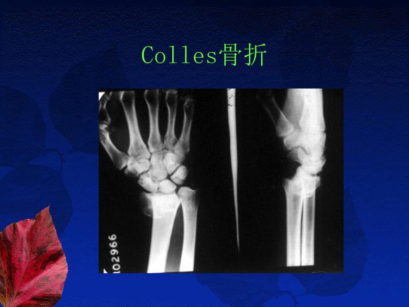 《colles骨折》PPT課件_第1頁(yè)