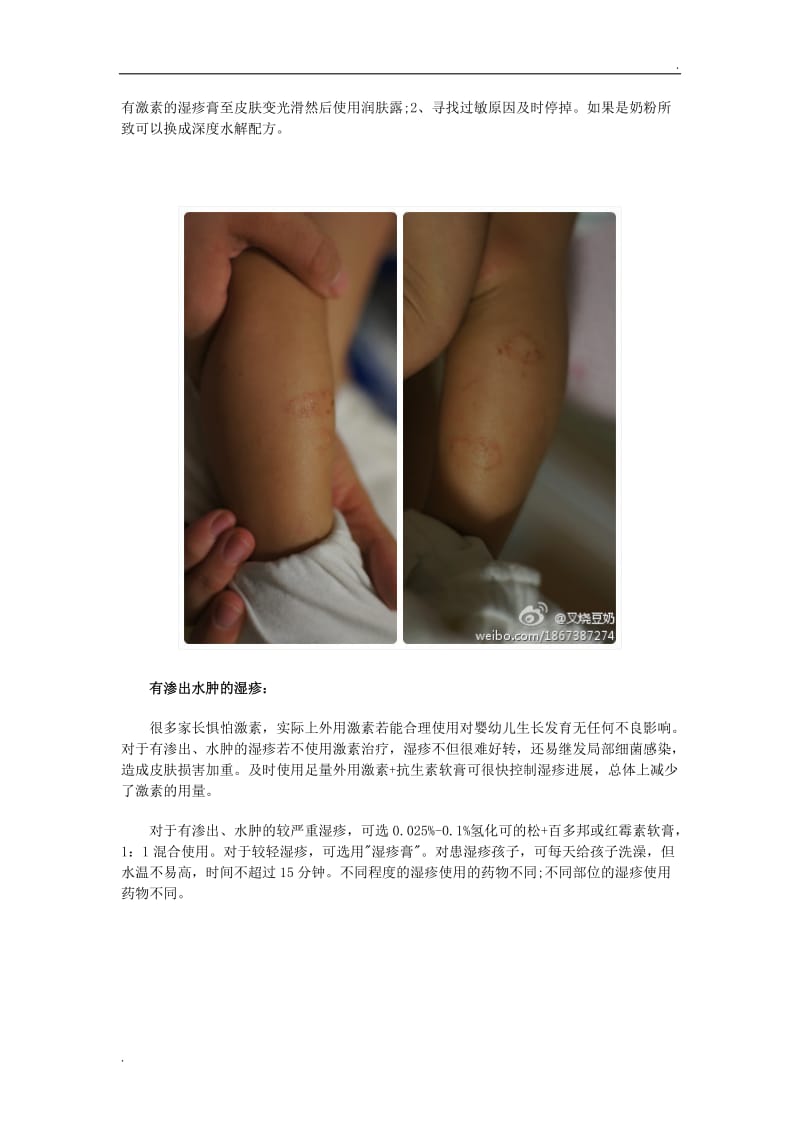 婴儿过敏的各种情况和应对方法_第3页