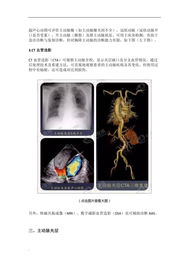主动脉夹层的影像诊断_第2页
